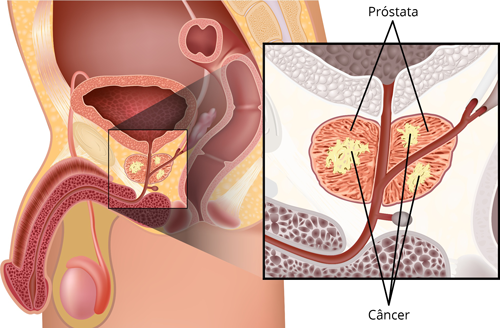 cancer de prostata articulos pdf